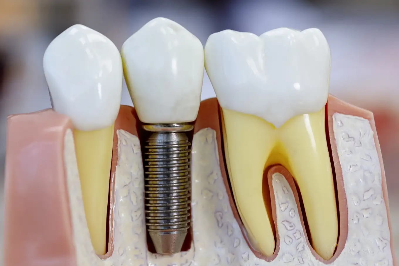 implant zębowy
